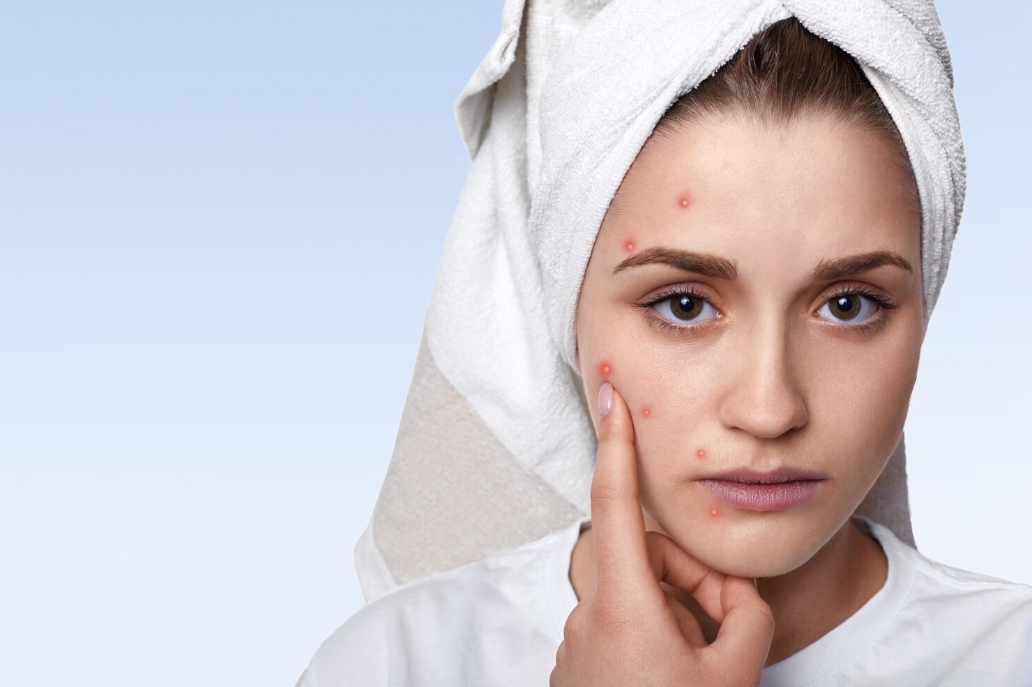 Acne Treatment East Delhi